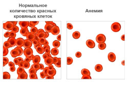 Анемия Анемия