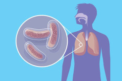 Туберкулез - повод для сдачи анализов на ВИЧ