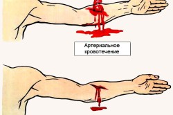 Виды кровотечений