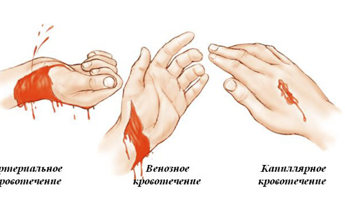 Виды кровотечений Виды кровотечений