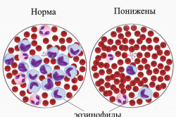 Понижение эозинофилов