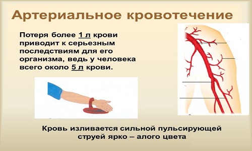 Как быстро остановить артериальное кровотечение?