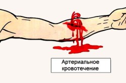 Артериальное кровотечение