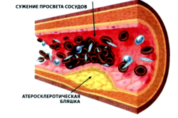 Атеросклероз - следствие гиперлипидемии