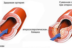 Схема развития атеросклероза 