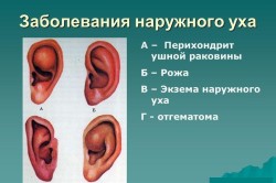 Заболевания наружного уха 