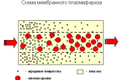 Схема мембранного плазмафереза
