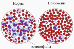 Норма и нехватка эозинофилов в крови