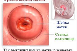 Эрозия шейки матки - причина кровотечения