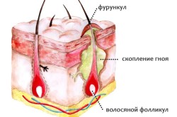 Фурункулез - показание к переливанию крови