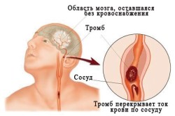 Атеросклероз головного мозга