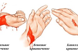 Виды кровотечений