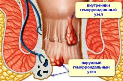 Схема кровотечения при геморрое