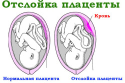 Отслойка плаценты - причина кровотечения
