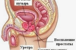 Простатит - причина крови в сперме