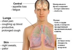 Туберкулез - причина мокроты с кровью
