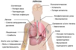 Общие симптомы лейкоза