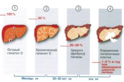Стадии гепатита 