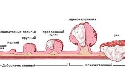 Рак - причина повышения лейкоцитов