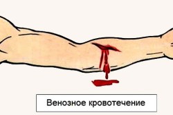 Венозное кровотечение Венозное кровотечение