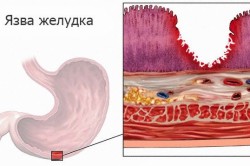 Язва желудка - фактор, провоцирующий пищеводное кровотечение 