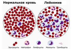 Рак крови (Лейкемия) Рак крови (Лейкемия)