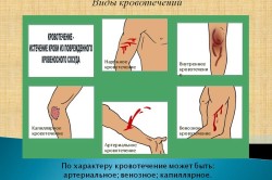 Виды кровотечений