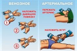 Схема остановки кровотечений
