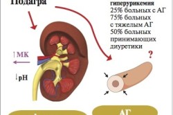 Схема гиперурикемии
