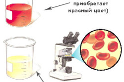 Гематурия Гематурия