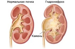 Гидронефроз как осложнение гемофилии