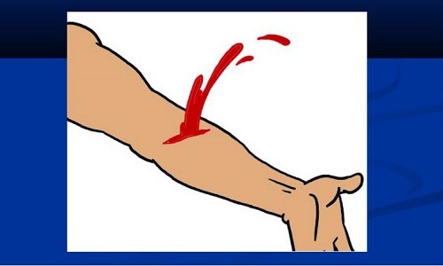 В чем заключается первая помощь при артериальном кровотечении