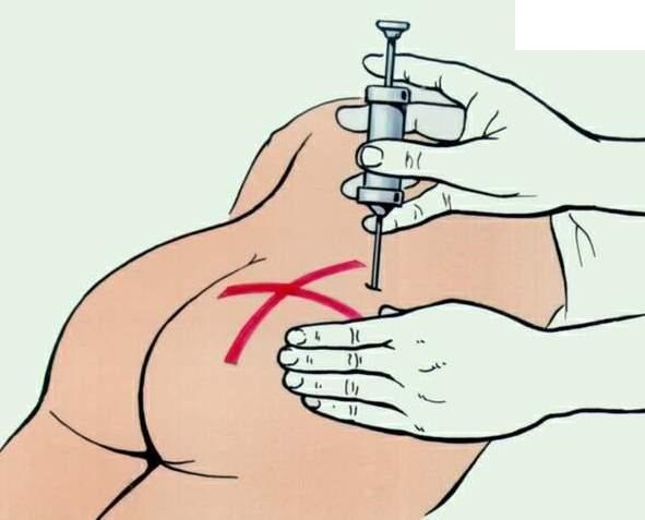 Зачем делают переливание крови из вены в ягодицу?