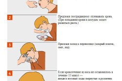 Первая помощь при кровотечении из носа