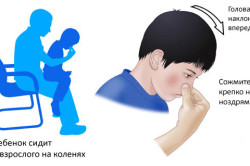 Оказание первой помощи при носовом кровотечении