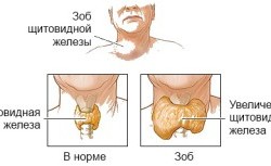 Симптомы заболевания щитовидной железы