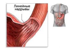 Синдром Мэлори - Вейса - причина желудочного кровотечения